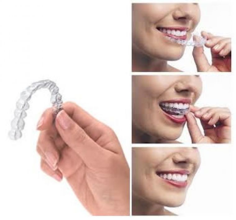Invisalign